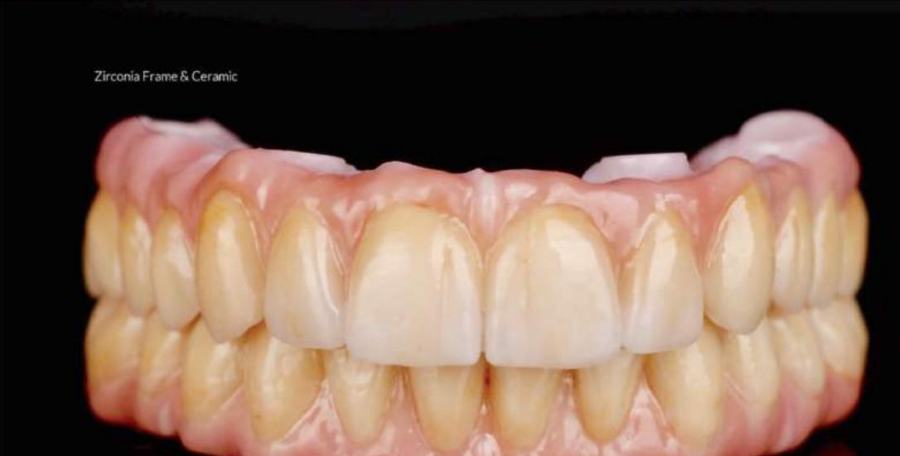 Struttura in zirconia e ceramica